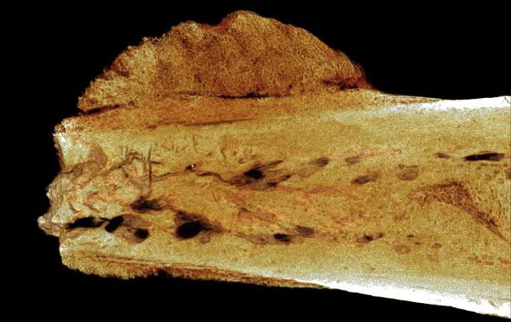 This micro-CT image shows a tumor in an ancient toe bone from a human relative