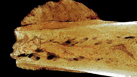 Earliest Human Cancer Found in 1.7-Million-Year-Old Bone